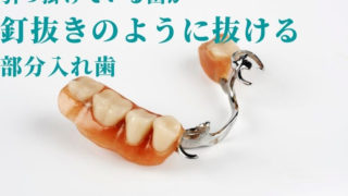 入れ歯で引っ掛けている歯がグラグラしてきた場合