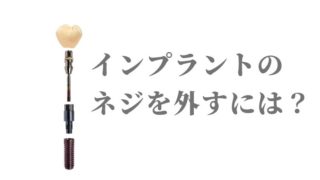 インプラントのネジを外すには？