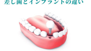 差し歯とインプラント