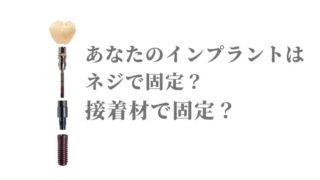 あなたが入れるインプラントはネジで固定？接着材で固定？