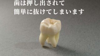 歯がグラグラして抜けてしまう原因は？