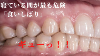 何もしなくても奥歯が痛い・・・原因は「食いしばり」
