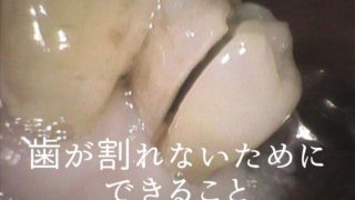 歯が割れないためにできる予防方法