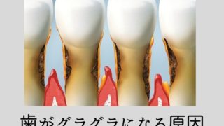 歯周病の進行で歯がグラグラになってきた