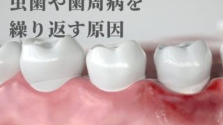 歯磨きしているのに虫歯や歯周病が治らない理由