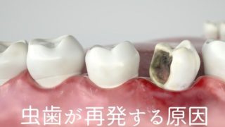 同じところが何度も虫歯を繰り返す理由