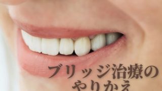 ブリッジ治療をやりかえる時に知っておくこと