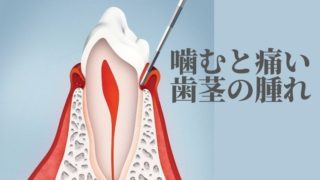 噛むと痛い、歯茎が腫れている。