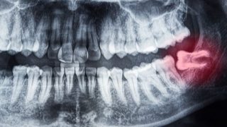 親知らずが原因で歪んだ他の歯は親知らずを抜けば元に戻りますか？