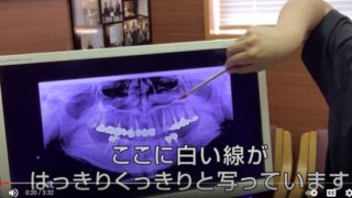 ブリッジ治療【地盤沈下編】