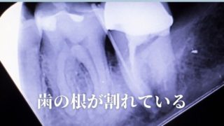 歯の根が割れていると言われました