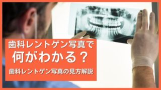 歯医者のレントゲン写真でわかること（抜歯診断、歯の神経の状態）