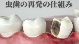 治療したはずの虫歯が再発する理由
