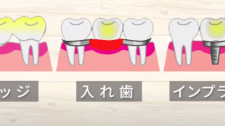 ブリッジ治療をした方は、以前のように噛んでいたらすぐに破壊されてしまいます