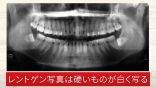 歯の神経が生きているか？死んでいるか？の判断