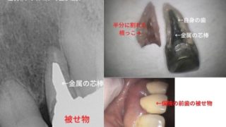 メタルコアで歯が破折している写真です