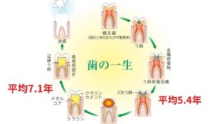 治療した歯の寿命は平均５～７年で再治療になります。
