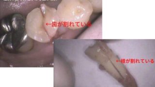 歯の根っこが割れた歯を放置しておくとどうなる？