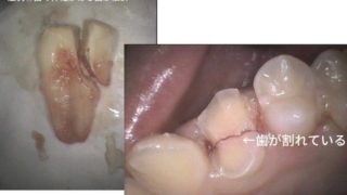 歯の神経がある健康な歯が「力」によって割れ抜歯になってしまった事例