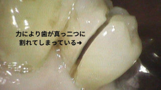 力により割れた歯はまき割りのように真っ二つな割れ方です。