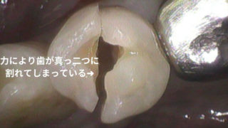 歯軋りや噛み締める力で歯が割れることがあります