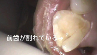 前歯が折れてしまっている症例