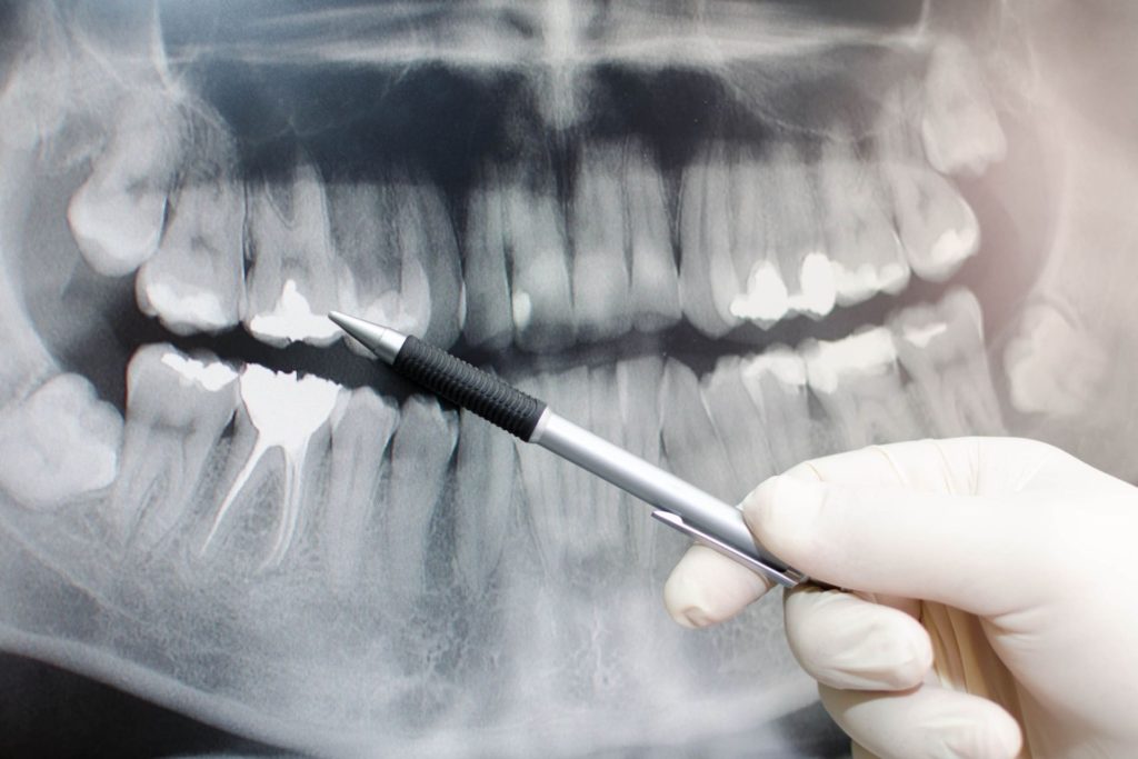 歯周病・歯槽膿漏の原因｜香川県 高松市 歯周病治療 吉本歯科医院