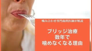 ブリッジ治療を選んだけど、数年で噛めなくなる理由