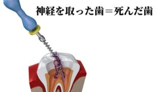 歯の神経を抜くってどういう意味ですか？