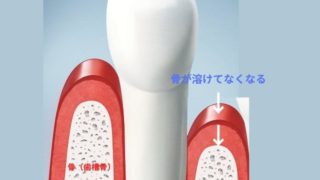 歯周病は骨が溶けてなくなる病気です。