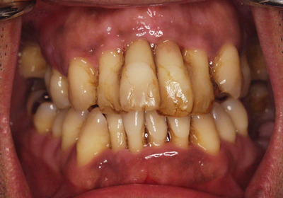 歯周病・歯槽膿漏の原因｜香川県 高松市 歯周病治療 吉本歯科医院