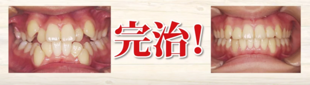 矯正治療で歯並びが崩れてくる原因｜高松市 マウスピース矯正 咬み合わせ専門 吉本歯科医院