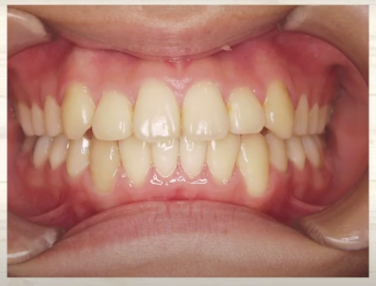 矯正治療で歯並びが崩れてくる原因|高松市 マウスピース矯正 咬み合わせ専門 吉本歯科医院