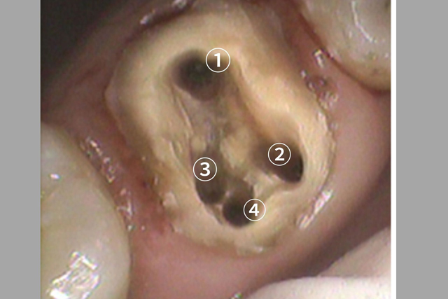 歯の神経を取る治療をしても歯が痛む理由｜香川県 高松市 吉本歯科医院