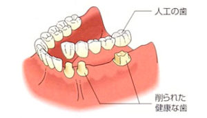 歯を削らないブリッジ治療｜香川県 高松市 吉本歯科医院