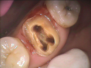 歯の神経のお痛みなら香川県高松市の歯の神経治療専門歯科 吉本歯科医院