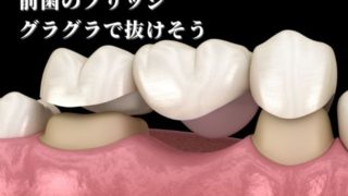 前歯のブリッジがグラグラで抜けそうになっている。治療法は？