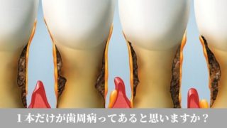 抜歯すれば歯周病は治りますか？