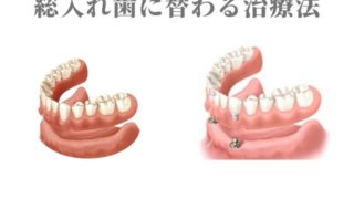総入れ歯の替わりになる治療法｜インプラント治療による固定式入れ歯