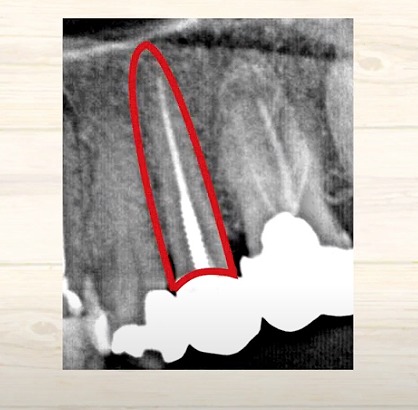 歯の神経のお痛みなら香川県高松市の歯の神経治療専門歯科 吉本歯科医院