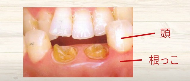 歯の神経のお痛みなら香川県高松市の歯の神経治療専門歯科 吉本歯科医院