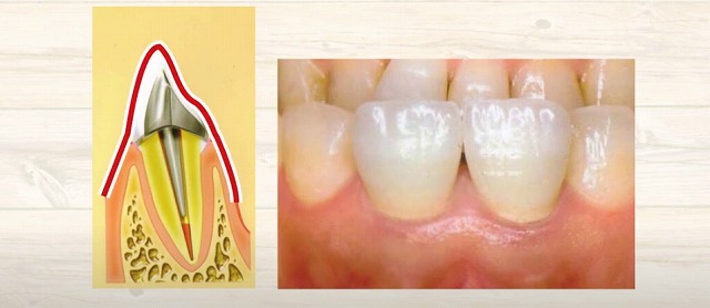 歯の神経のお痛みなら香川県高松市の歯の神経治療専門歯科 吉本歯科医院