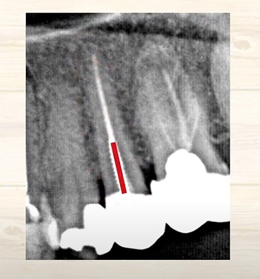 歯の神経のお痛みなら香川県高松市の歯の神経治療専門歯科 吉本歯科医院