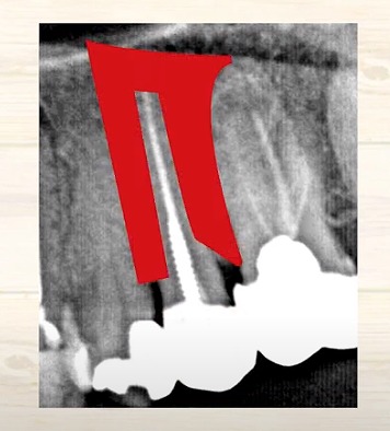 歯の神経のお痛みなら香川県高松市の歯の神経治療専門歯科 吉本歯科医院