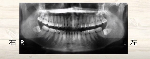 歯の神経のお痛みなら香川県高松市の歯の神経治療専門歯科 吉本歯科医院