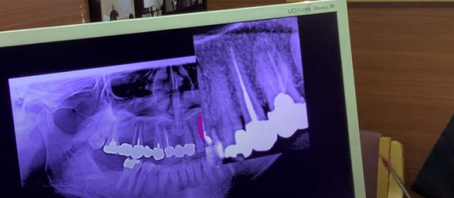 歯の神経のお痛みなら香川県高松市の歯の神経治療専門歯科 吉本歯科医院