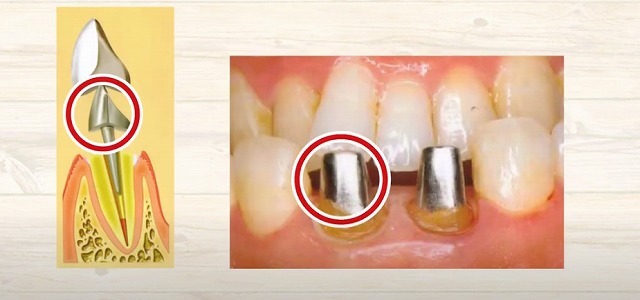 歯の神経のお痛みなら香川県高松市の歯の神経治療専門歯科 吉本歯科医院