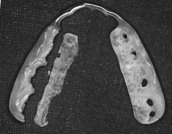 歯の破壊を防ぐマウスピース｜香川県高松市の吉本歯科医院