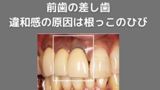 差し歯にしている前歯に違和感がある｜原因は根っこのひびわれ