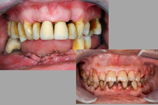 重度の歯周病の治療｜香川県 高松市 吉本歯科医院
